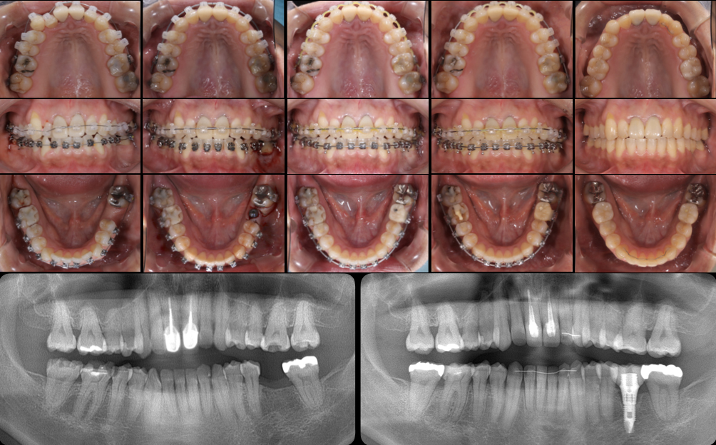 矯正とインプラント