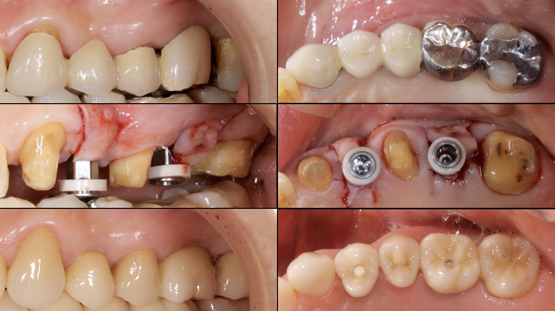 成熟側インプラント埋入