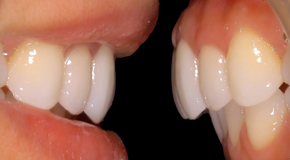口唇の真下に歯があるため、歯の並びが変わると口唇の形にも影響する