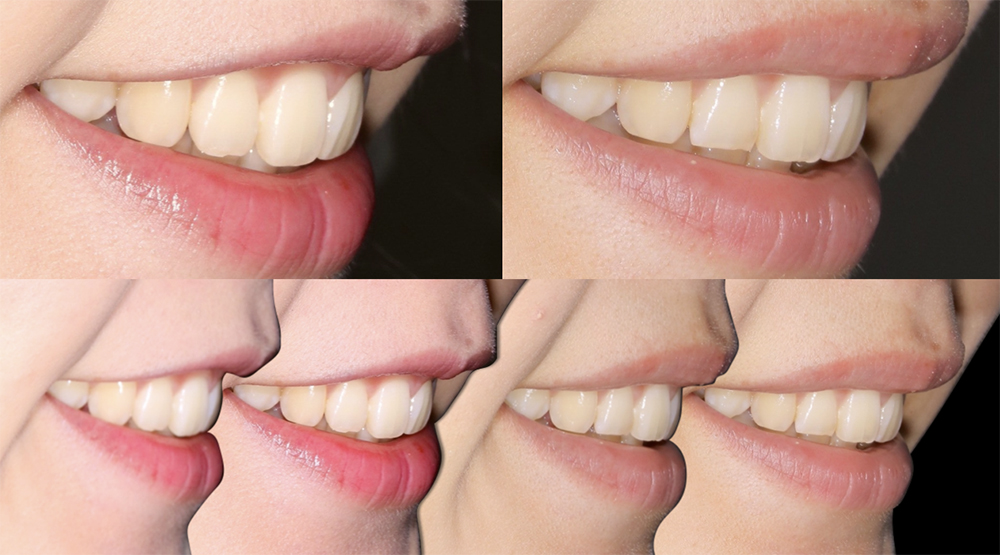 患者のキャラクタライズに合わせた歯の形態を再現するために形態修正を行なった症例