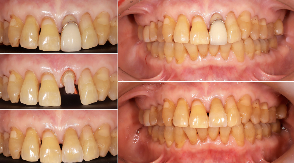 患者が客観的審美よりも周囲の歯との調和を希望した症例