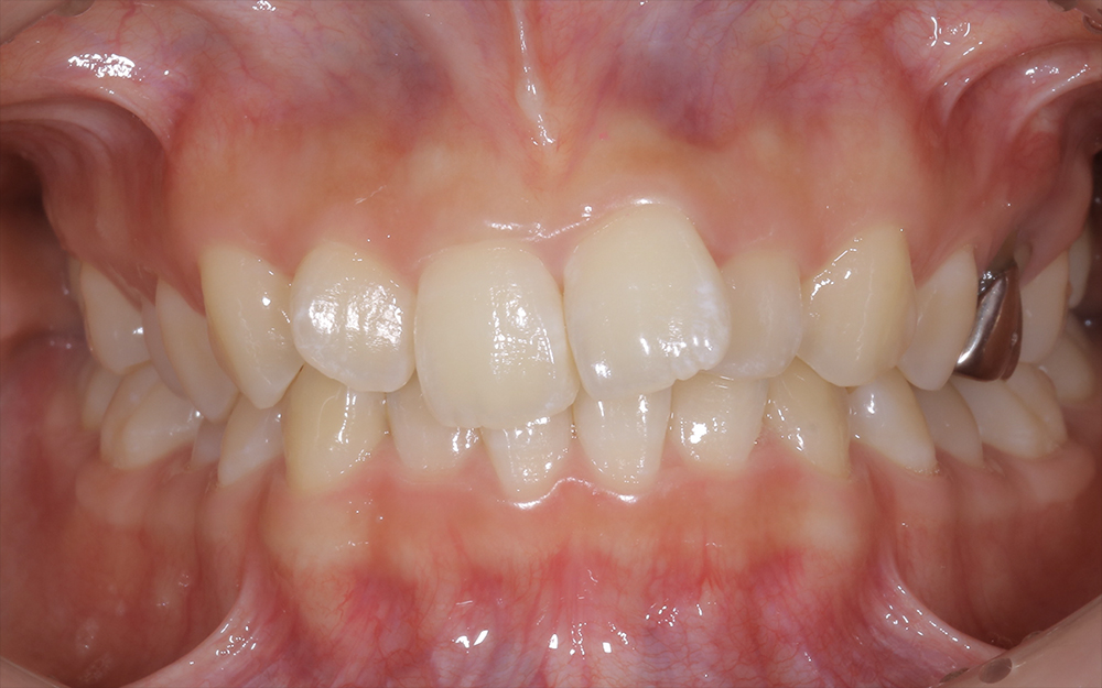 前歯の歯列不正をワイヤー矯正によって矯正治療を行った症例