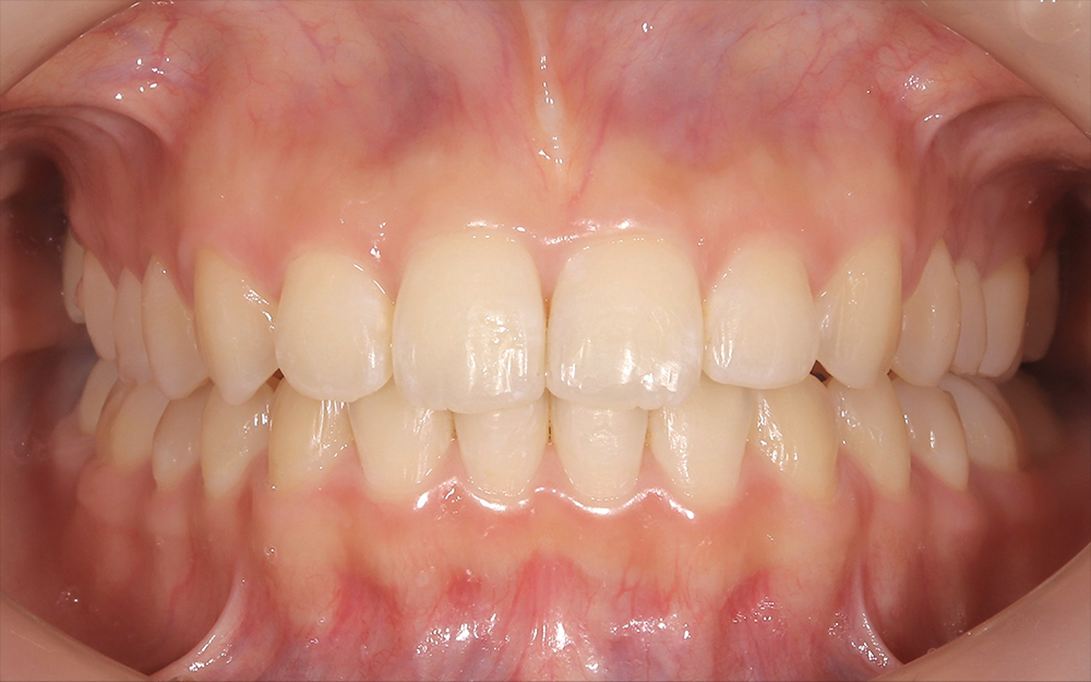 前歯の歯列不正をワイヤー矯正によって矯正治療を行った症例
