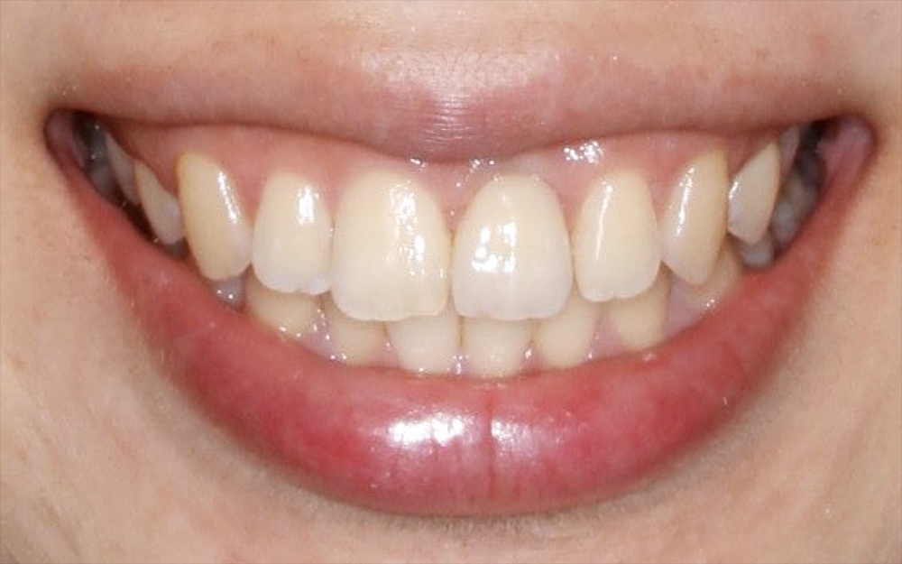 左上前歯の外傷歯を抜歯してインプラントによって審美回復した症例