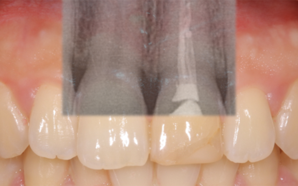 左上前歯の外傷歯を抜歯してインプラントによって審美回復した症例