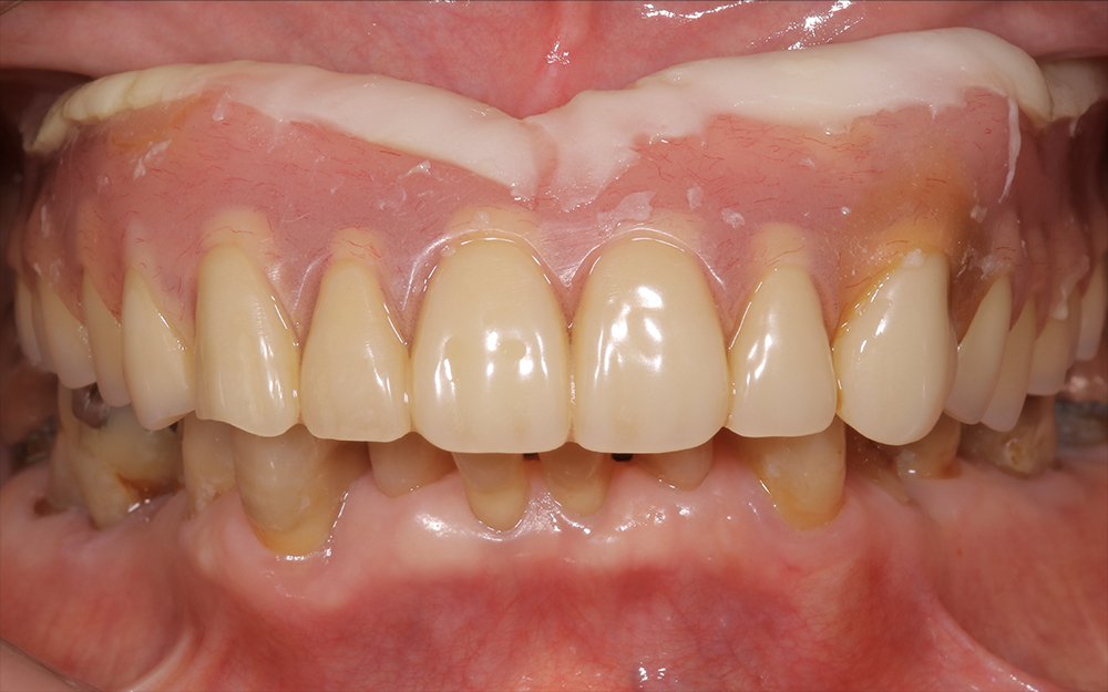 前歯の突出感を抑え口元の見た目に重視した入れ歯治療の症例
